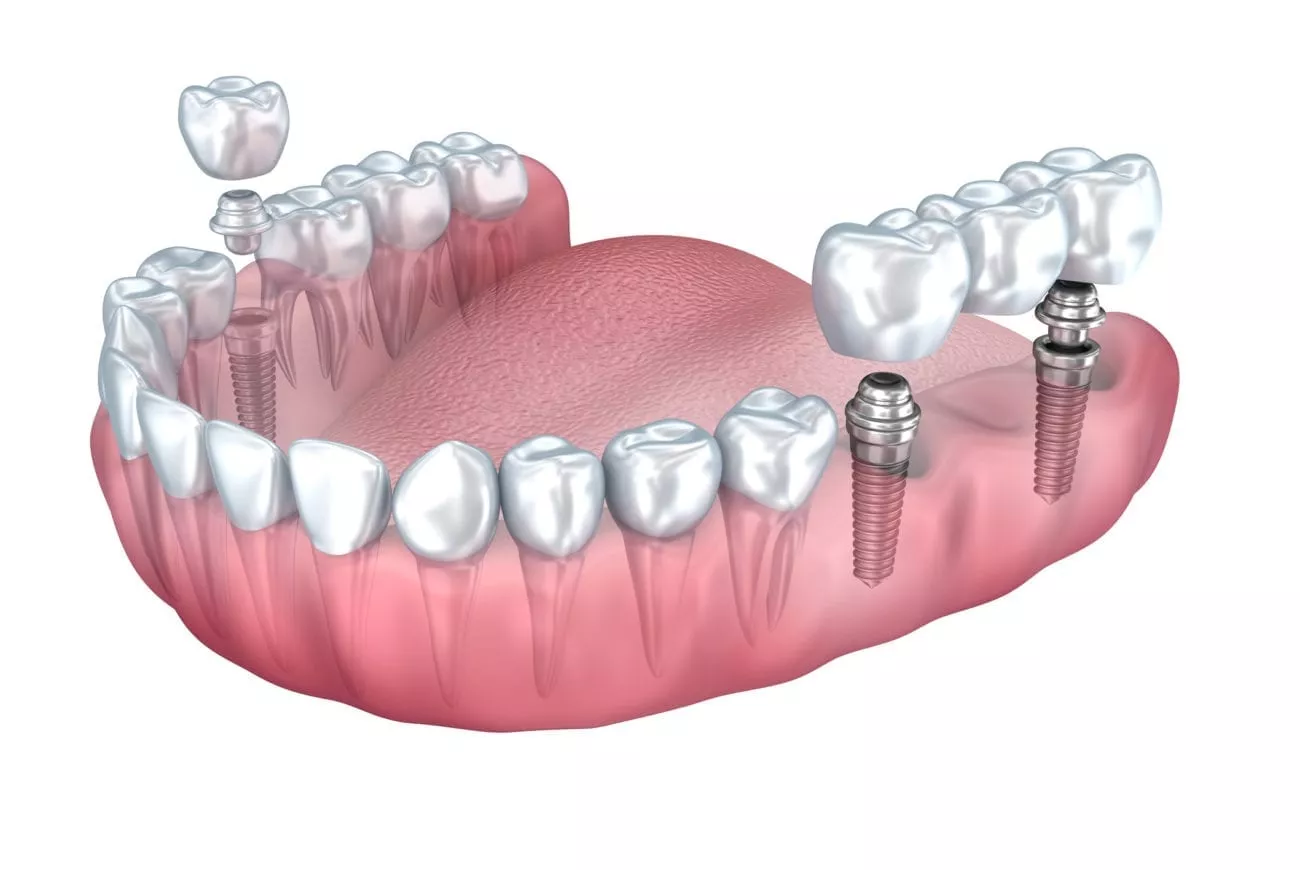 3D model of dental implants