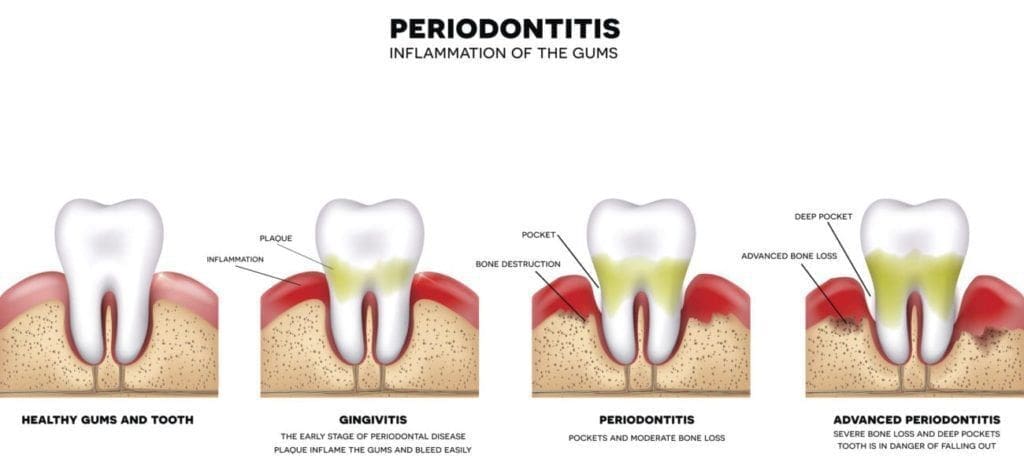 Periodontal Therapy