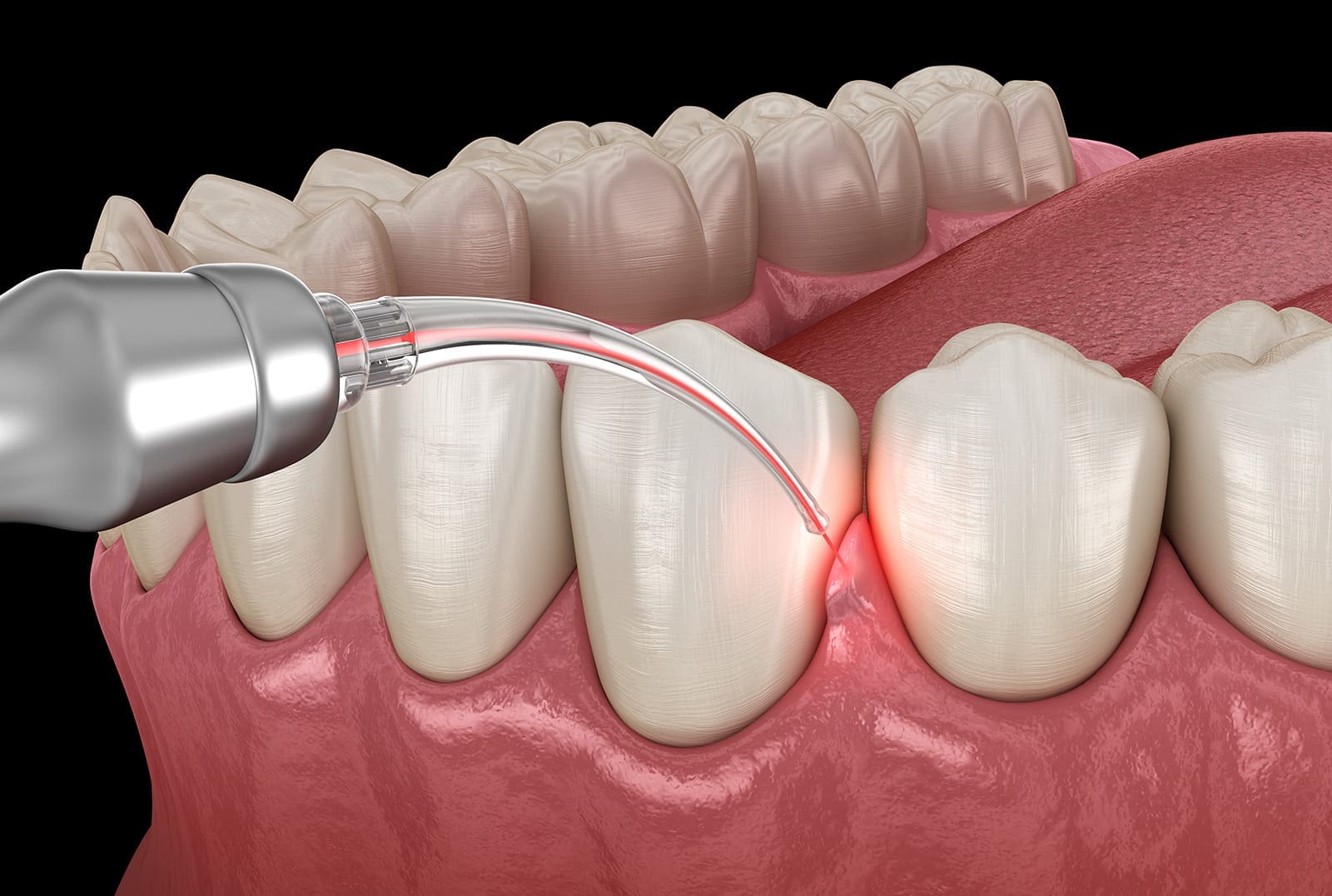 Laser dentistry treatment at Corbin Dental.